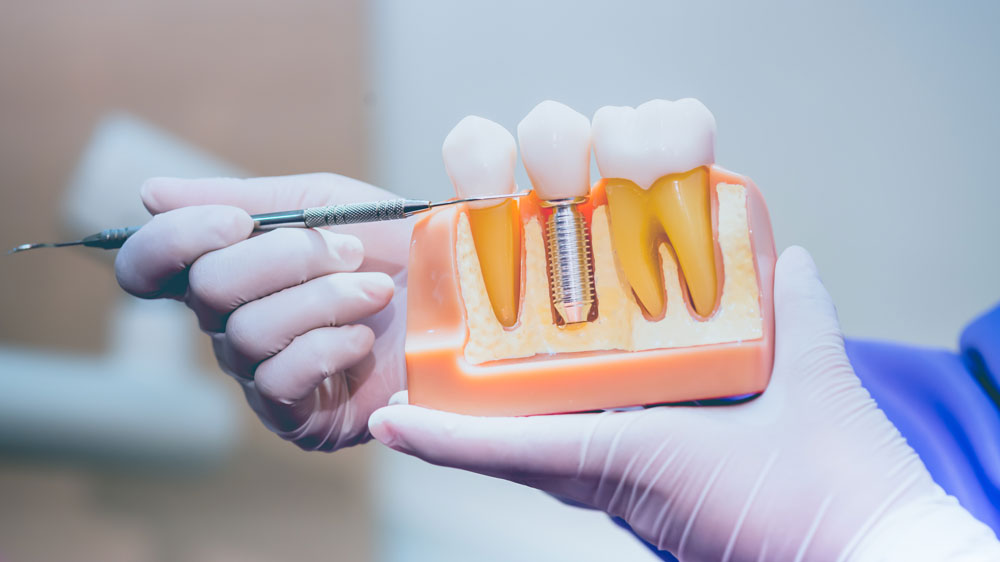 In modern restorative dentistry the value of the bonding evolution has delivered huge strength and longevity benefits for damaged teeth.